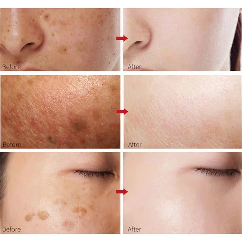 Whitening Freckles Cream - Korean Skincare