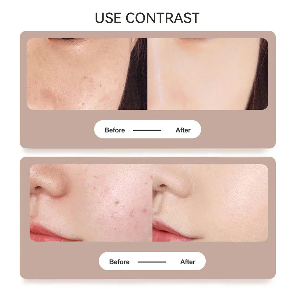 Clear Nevus Beauty Pen - Mole, Black Points, Wart, Spot, Tattoo Remover