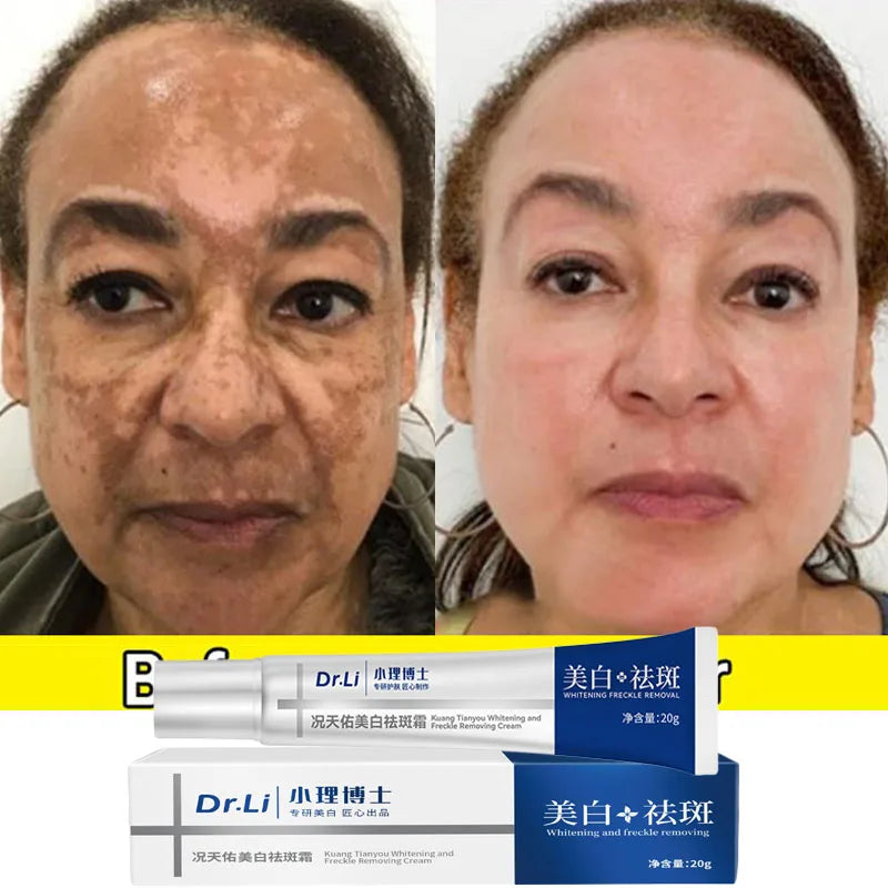 Whitening Freckles Cream - Korean Skincare