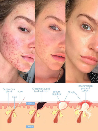 High Frequency Facial Machine with Argon Treatment - Electrotherapy Wand for Acne and Hair Care