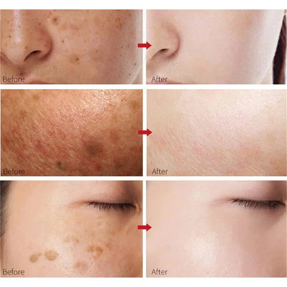 Whitening Freckles Cream - Korean Skincare