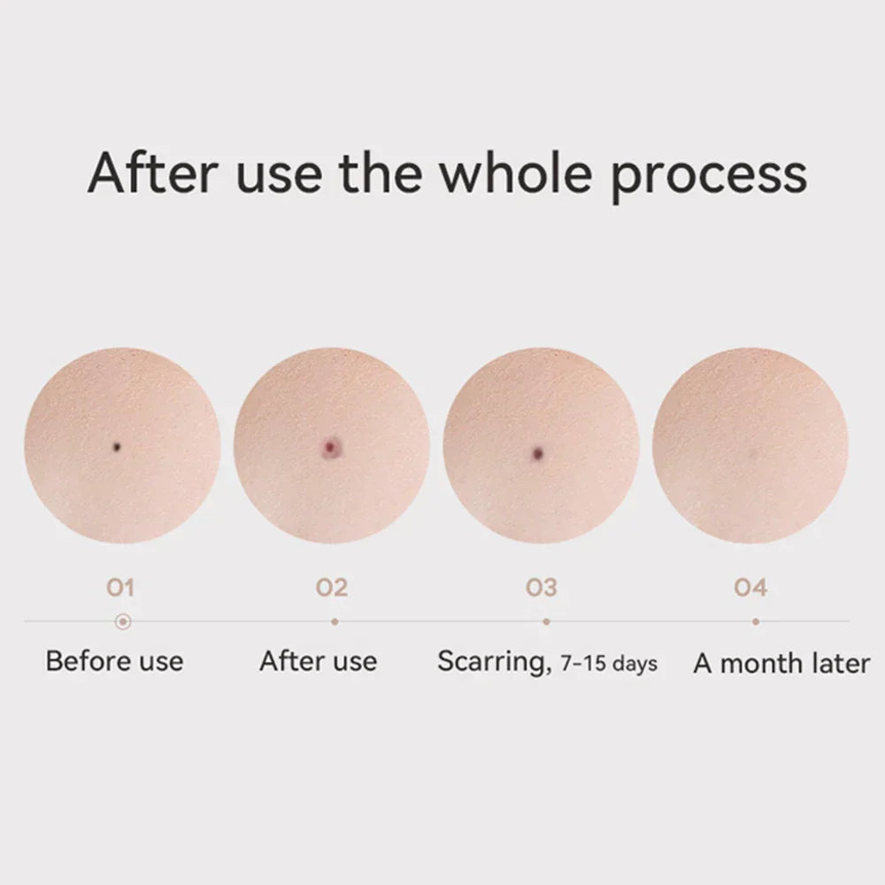 Clear Nevus Beauty Pen - Mole, Black Points, Wart, Spot, Tattoo Remover