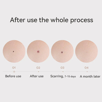 Clear Nevus Beauty Pen - Mole, Black Points, Wart, Spot, Tattoo Remover