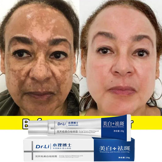 Whitening Freckles Cream - Korean Skincare